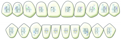 .022 Neolucent Plus Roth Ceramic Bracket 10 Cases 