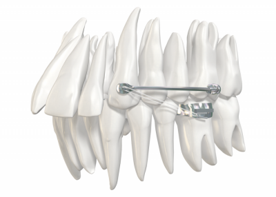 Carriere Motion Kit Standard (23, 25, 27) Qty. 3 